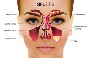 Penyebab Umum Terjadinya Sinusitis pada Seseorang